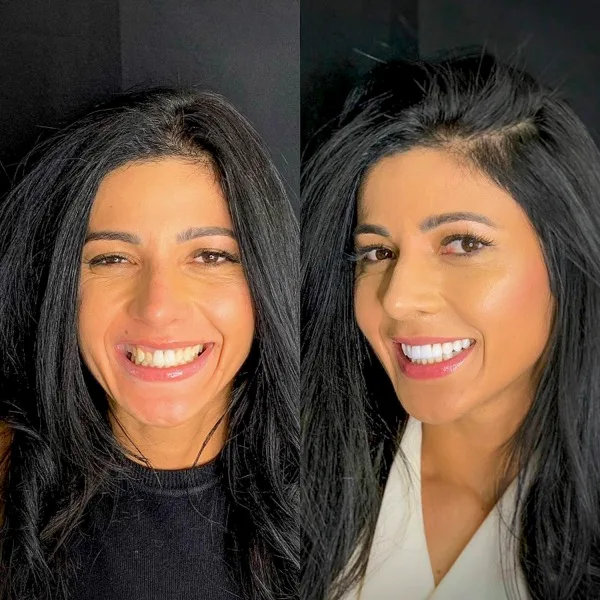 Paciente sorrindo após lentes de contato dental